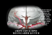 아태지역 심장 전문의들, 심방세동으로 인한 뇌졸중 위험 경고
