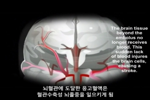 아태지역 심장 전문의들, 심방세동으로 인한 뇌졸중 위험 경고