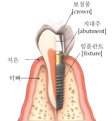 임플란트 전문의가 시술합니다 는 불법