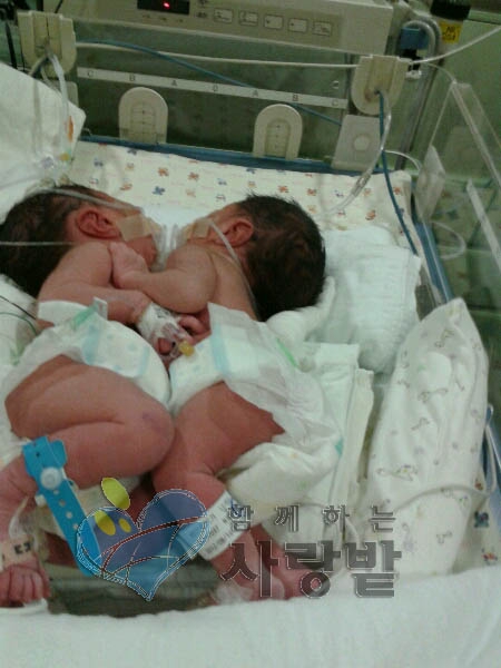 샴쌍둥이 씩씩이와 다정이, 심장분리수술 시급…수술비 없어 안따까워