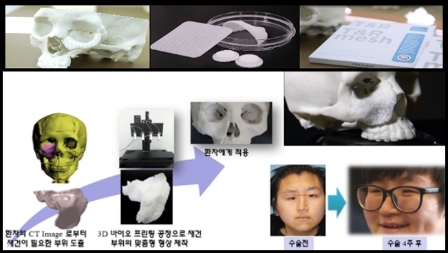 얼굴뼈 손상환자도 3D프린팅 기술로 시간 단축