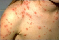 수두 환자 집단발생 증가, 지금이라도 접종해야