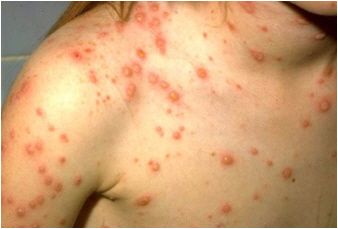 수두 환자 집단발생 증가, 지금이라도 접종해야