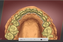 ‘치열 유지용 와이어 자동화 밴딩 시스템’ 기술 개발